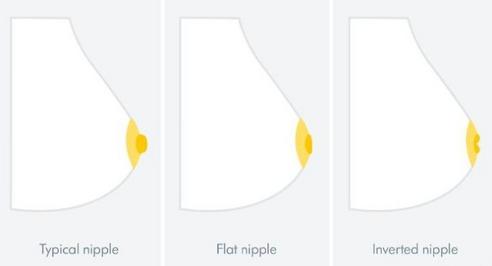 Breastfeeding With Inverted Nipples and Flat Nipples